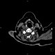 Remnant of thyreoglossal duct: CT - Computed tomography