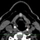 Remnant of thyreoglossal duct: CT - Computed tomography