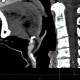 Remnant of thyreoglossal duct: CT - Computed tomography