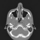 Pharyngeal tonsil, enlargement: CT - Computed tomography