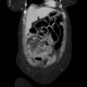 Torsion of the mesentery: CT - Computed tomography