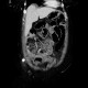 Torsion of the mesentery: CT - Computed tomography