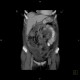 Torsion of the mesentery: CT - Computed tomography