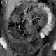 Torsion of the mesentery: CT - Computed tomography