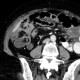 Torsion of the mesentery: CT - Computed tomography