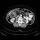 Torsion of the mesentery: CT - Computed tomography