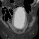 Hypertrophy of bladder wall, urinary bladder, hydronephrosis, CT cystography: CT - Computed tomography