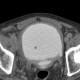 Hypertrophy of bladder wall, urinary bladder, hydronephrosis, CT cystography: CT - Computed tomography