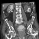 Hypertrophy of bladder wall, urinary bladder, hydronephrosis, CT cystography: CT - Computed tomography