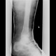 Thrombosis of muscular veins of the calf, fracture of the fibular ankle and plaster cast: X-ray - Plain radiograph