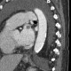 Thrombosis of the left auricula, an incidental finding on CT angiography: CT - Computed tomography