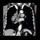 Lung tumour, hilar lymphadenopathy: CT - Computed tomography