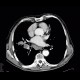 Lung tumour, hilar lymphadenopathy: CT - Computed tomography