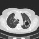 Tuberculosis, pulmonary tuberculosis, cavern: CT - Computed tomography