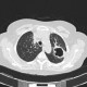 Tuberculosis, pulmonary tuberculosis, cavern: CT - Computed tomography