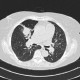 Tuberculosis, pulmonary tuberculosis, cavern: CT - Computed tomography