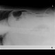 Carcinoma of transverse colon, ileus, perforation of bowel, peritonitis: X-ray - Plain radiograph