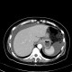 Carcinoma of transverse colon, ileus, perforation of bowel, peritonitis: CT - Computed tomography