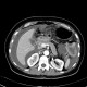 Carcinoma of transverse colon, ileus, perforation of bowel, peritonitis: CT - Computed tomography