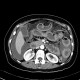 Carcinoma of transverse colon, ileus, perforation of bowel, peritonitis: CT - Computed tomography