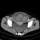 Carcinoma of transverse colon, ileus, perforation of bowel, peritonitis: CT - Computed tomography