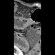 Carcinoma of transverse colon, ileus, perforation of bowel, peritonitis: CT - Computed tomography