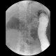 Carcinoma of transverse colon, ileus, perforation of bowel, peritonitis: RF - Fluoroscopy