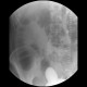 Carcinoma of transverse colon, ileus, perforation of bowel, peritonitis: RF - Fluoroscopy