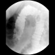 Carcinoma of transverse colon, ileus, perforation of bowel, peritonitis: RF - Fluoroscopy
