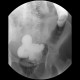 Carcinoma of transverse colon, ileus, perforation of bowel, peritonitis: RF - Fluoroscopy