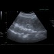 Carcinoma of transverse colon, ileus, perforation of bowel, peritonitis: US - Ultrasound