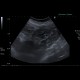 Carcinoma of transverse colon, ileus, perforation of bowel, peritonitis: US - Ultrasound