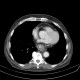 Carcinoma of esophagus, distal esophagus, placement of stent, liver metastasis: CT - Computed tomography