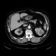 Renal carcinoma, treatment with RFA, follow-up: CT - Computed tomography