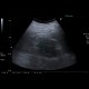 Renal carcinoma, treatment with RFA, follow-up: US - Ultrasound