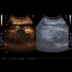 Renal carcinoma, treatment with RFA, follow-up, CEUS: US - Ultrasound