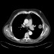 Lung tumour, bone metastasis in pubic bone, inguinal hernia: CT - Computed tomography