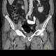 Lung tumour, bone metastasis in pubic bone, inguinal hernia: CT - Computed tomography