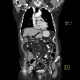 Carcinoma of pancreas: CT - Computed tomography