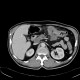 Colorectal cancer, carcinoma of transverse colon, lymphadenopathy, liver metastases: CT - Computed tomography