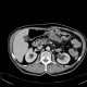 Colorectal cancer, carcinoma of transverse colon, lymphadenopathy, liver metastases: CT - Computed tomography