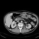 Colorectal cancer, carcinoma of transverse colon, lymphadenopathy, liver metastases: CT - Computed tomography