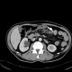 Colorectal cancer, carcinoma of transverse colon, lymphadenopathy, liver metastases: CT - Computed tomography