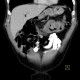 Colorectal cancer, carcinoma of transverse colon, lymphadenopathy, liver metastases: CT - Computed tomography