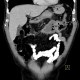 Colorectal cancer, carcinoma of transverse colon, lymphadenopathy, liver metastases: CT - Computed tomography
