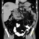 Colorectal cancer, carcinoma of transverse colon, lymphadenopathy, liver metastases: CT - Computed tomography