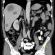 Colorectal cancer, carcinoma of transverse colon, lymphadenopathy, liver metastases: CT - Computed tomography