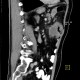 Colorectal cancer, carcinoma of transverse colon, lymphadenopathy, liver metastases: CT - Computed tomography