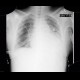 Cardiac tamponade, pericardial effusion: X-ray - Plain radiograph