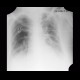 Pneumonia, pleural effusion, correlation: X-ray - Plain radiograph